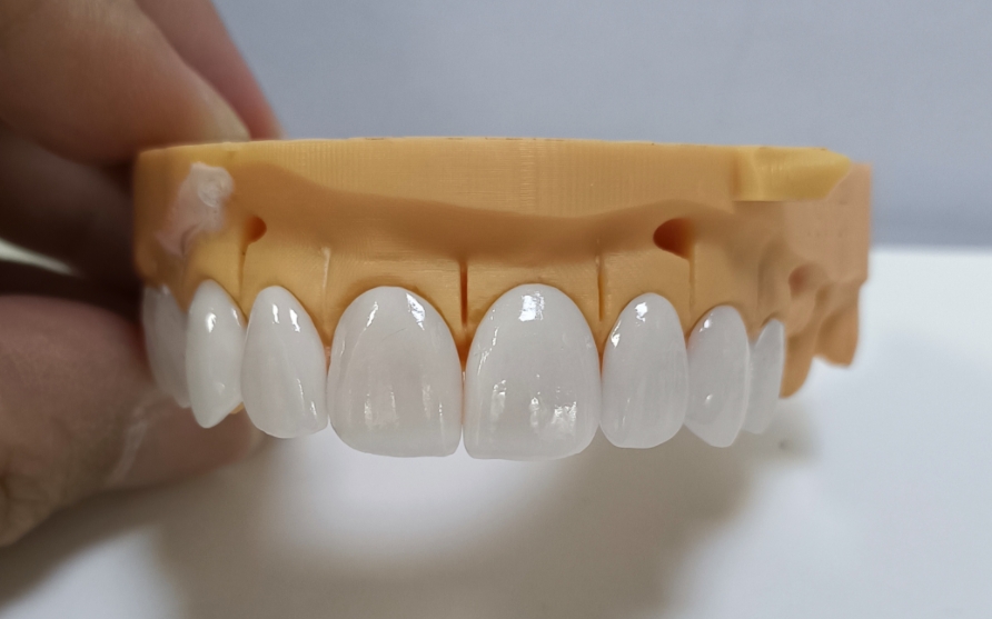 High Esthetic Emax Veneers