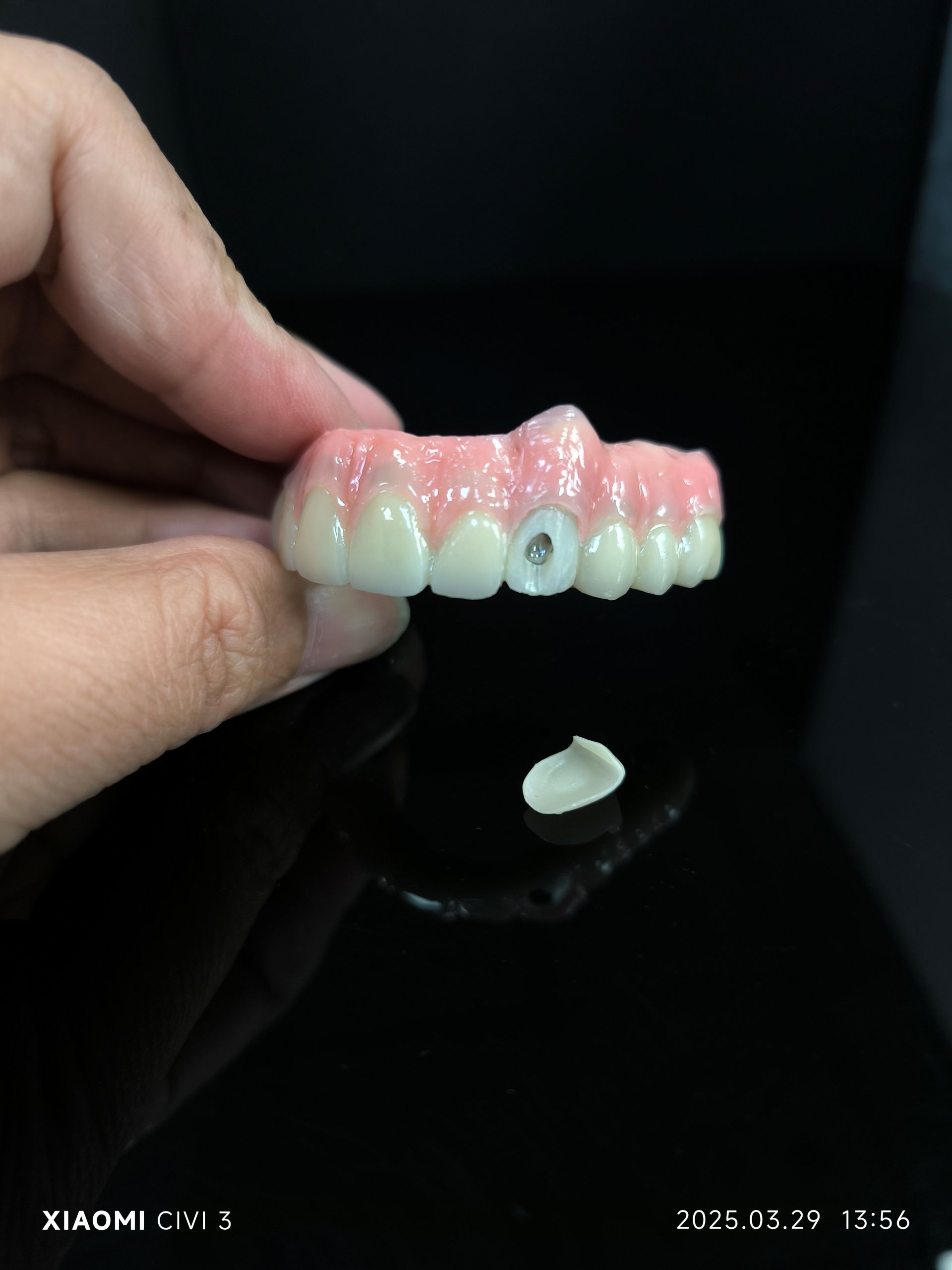 All on 4 -  Hybrid zirconia bridge solution for vestibular screw hole