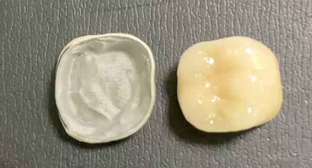 What conditions are required for getting porcelain-fused-to-metal crowns?