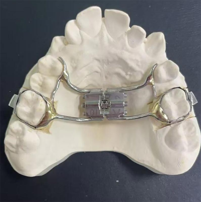 What is a Rapid Maxillary Expander (RME)?