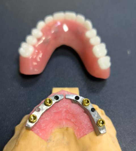 Locator and Titanium Dental Bar