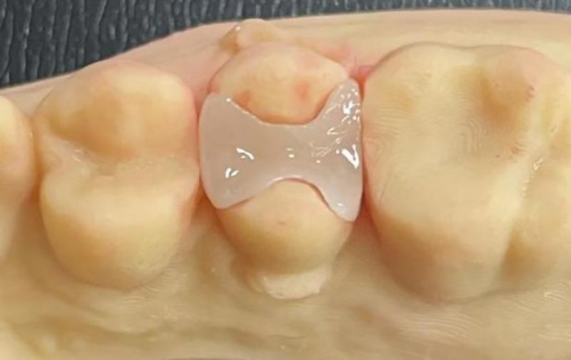 What Are the Differences Between Inlays and Post-Core Crowns?
