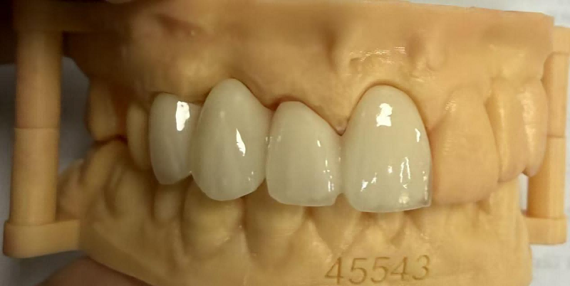 Why Do Dental Crown Edges Turn Black? And How to Fix It