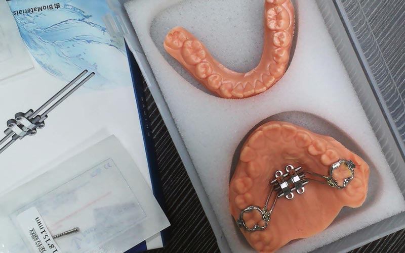 Understand MSE Skeletal Expansion with WM Dental Lab