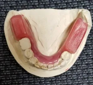 Clinical Guide to Denture Occlusal Rims: Function, VDO, and Step-by-Step Application