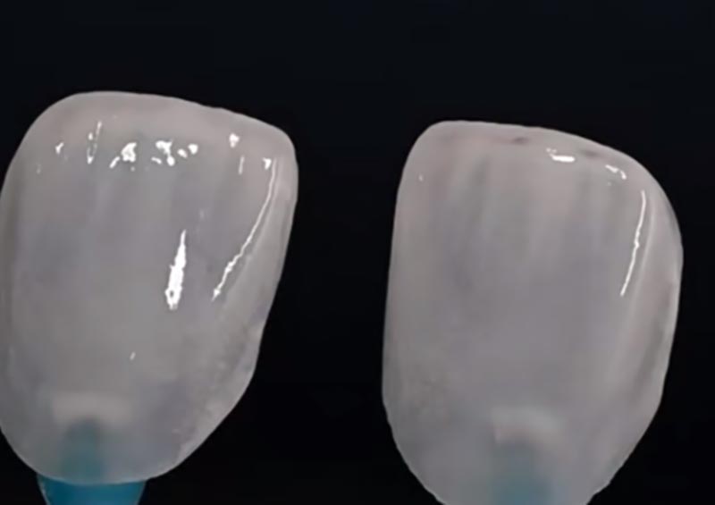 Veneers vs Crowns: How to Choose the Right Restoration for Optimal Aesthetic and Functional Outcomes