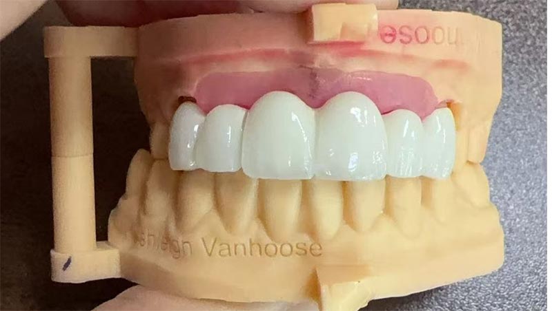 Black Triangles in Orthodontic Treatment