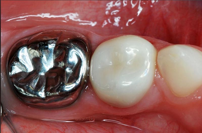 Full-Cast Metal Crowns and Bridges for Posterior Restorations