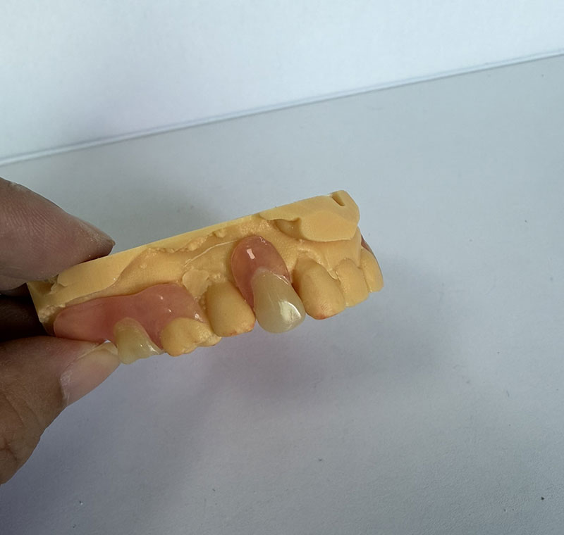 Valplast Partials at WM Dental Lab