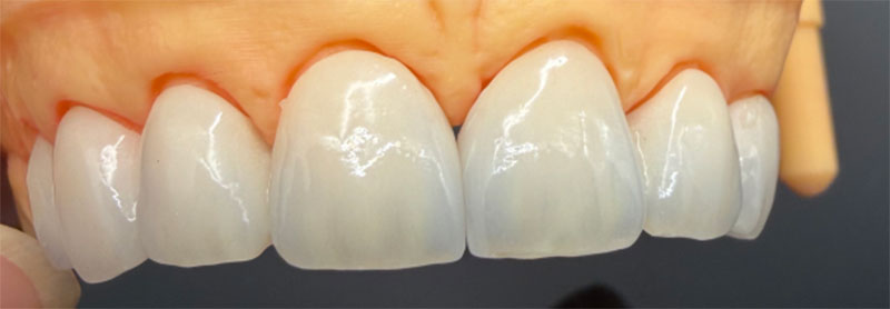 Impact of Non-Vital Teeth on All-Ceramic Crowns and Corresponding Treatments