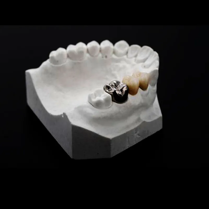 When Should Clinicians Choose a Full Metal Crown for Posterior Restorations?
