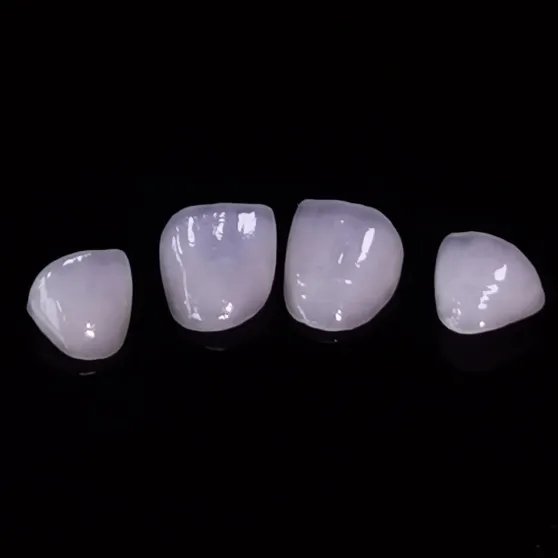 How Did One Professional Finally Smile Confidently in Every Meeting After Getting High Esthetic Emax Veneers?