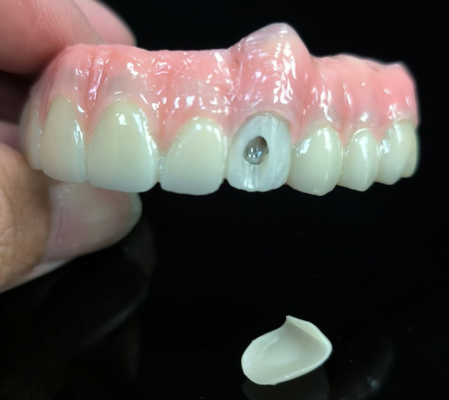 All on 4 hybrid -  Hybrid zirconia bridge solution for vestibular screw hole