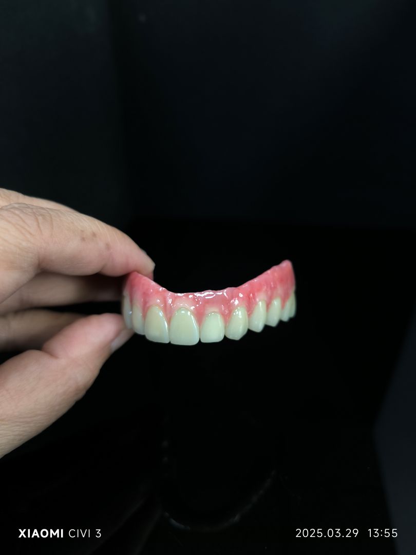 All on 4 hybrid -  Malo Bridge Full Zirconia Crowns Over titanium Structure