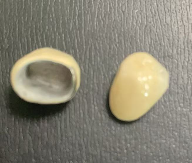 PFM crowns