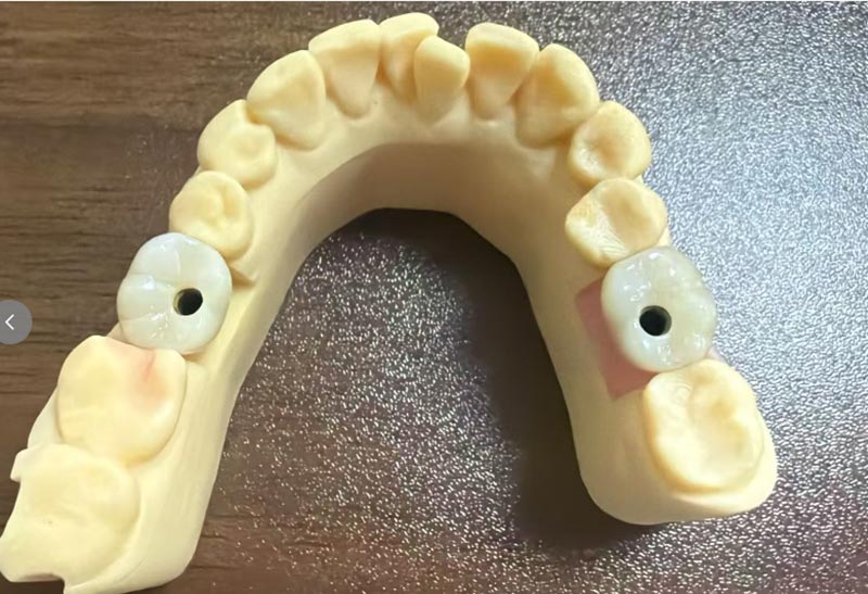 dental implants