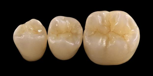 <h2>Zirconia in Dentistry: Indications, Advantages, and Clinical Considerations</h2>
<p>
Zirconia is widely recognized for its strength and durability. The latest generations of zirconia materials also offer significantly improved aesthetic properties. For patients considering all-ceramic restorations, it is essential to carefully evaluate both the indications and limitations of zirconia-based systems.
</p>
<p>
Today’s patients increasingly expect restorations that combine excellent aesthetics with full functional performance. Most modern ceramic systems can meet these expectations, but clinical success largely depends on proper material selection, tooth preparation, and cementation protocols. The choice should be guided by key material properties such as fracture resistance, flexural strength, wear resistance, and long-term stability. Among these materials, zirconia has become one of the most widely used options in contemporary restorative dentistry.
</p>
<h3>Why Choose Zirconia?</h3>
<p>
Zirconia is valued for its exceptional strength and long-term durability. Modern zirconia is significantly different from earlier generations, which were more opaque and less aesthetic. Today, CAD/CAM technology enables precise fabrication of zirconia restorations with improved optical properties.
</p>
<p>
Restorations can be designed as:
</p>
<ul>
<li><strong>Monolithic zirconia:</strong> Ideal for posterior crowns and bridges, offering high strength and durability.</li>
<li><strong>Layered zirconia:</strong> Suitable for cases requiring enhanced aesthetics, including long-span restorations across different areas of the mouth.</li>
</ul>
<p>
Flexural strength varies depending on the type, ranging from approximately 590 MPa in high-translucency zirconia to up to 1400 MPa in monolithic forms. Zirconia restorations can be cemented using self-adhesive resin cements or resin-modified glass ionomer cements.
</p>
<h3>Key Factors in Zirconia Material Selection</h3>
<p>
When considering zirconia for an all-ceramic restoration, clinicians should evaluate several critical factors:
</p>
<ul>
<li>Remaining tooth structure</li>
<li>Location in the oral cavity (aesthetic zone vs functional zone)</li>
<li>Presence of parafunctional habits such as bruxism</li>
<li>Translucency of adjacent natural teeth</li>
<li>Color and condition of underlying tooth structure</li>
</ul>
<p>
The aesthetic zone typically includes the anterior teeth, although in some patients it may extend to the first molar depending on smile line and facial dynamics. The functional zone generally includes premolars and molars, where occlusal forces are significantly higher.
</p>
<h3>Functional Zone Applications</h3>
<p>
In posterior regions, occlusal forces must be carefully considered. Zirconia is an excellent alternative to traditional PFM restorations, especially in cases with limited restorative space. Modern monolithic zirconia allows full-contour design of occlusal anatomy, including functional cusps and marginal ridges, while maintaining high strength.
</p>
<p>
Current evidence shows that monolithic zirconia is well suited for posterior crowns and multi-unit bridges due to its excellent resistance to fracture and wear. Advances in adhesive techniques and preparation design have also improved long-term clinical outcomes.
</p>
<h3>Aesthetic Zone Applications</h3>
<p>
In the anterior region, restorations must closely replicate natural tooth color, translucency, and light behavior. While materials such as lithium disilicate offer excellent aesthetics, they are less strong and typically require adhesive bonding.
</p>
<p>
A key advantage of zirconia is its ability to be conventionally cemented while still achieving high aesthetic performance. With the development of high-translucency and multilayer zirconia systems, it is now possible to produce restorations that closely mimic natural dentition.
</p>
<p>
Advanced processing techniques further enhance optical properties and reduce imperfections that may affect light transmission and appearance.
</p>
<h3>Strength and Aesthetics Combined</h3>
<p>
Early zirconia systems prioritized strength but lacked aesthetic quality. Modern monolithic zirconia successfully combines both strength and improved appearance, making it suitable for a wide range of clinical cases.
</p>
<p>
It is particularly beneficial for patients with parafunctional habits or previous restoration failures. Clinical studies indicate high patient acceptance and low complication rates.
</p>
<p>
Concerns regarding wear on opposing dentition have been reduced with newer formulations. Highly polished zirconia surfaces demonstrate low abrasive potential, and in some cases may be gentler than traditional porcelain-fused-to-metal restorations.
</p>
<h3>Zirconia Implants: Emerging Alternative</h3>
<p>
While titanium implants remain the clinical standard, zirconia implants are gaining attention as a metal-free alternative. Early designs were primarily one-piece systems, but two-piece zirconia implants now allow for improved prosthetic flexibility.
</p>
<p>
Zirconia implants are particularly useful in cases where aesthetic concerns exist, such as potential gray discoloration of peri-implant tissues or thin gingival biotype. They may also be considered for patients with rare titanium sensitivity.
</p>
<p>
However, zirconia implants are still relatively new, and long-term clinical data remains limited compared to titanium systems.
</p>
<h3>Conclusion</h3>
<p>
Zirconia has evolved into a highly versatile material in restorative dentistry, offering a strong balance between mechanical performance and aesthetics. Proper case selection and adherence to clinical protocols are essential for achieving optimal results in both anterior and posterior applications.
</p>