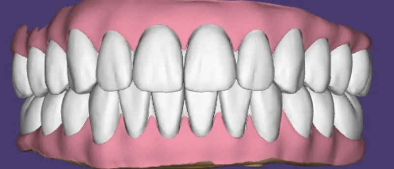 Removable