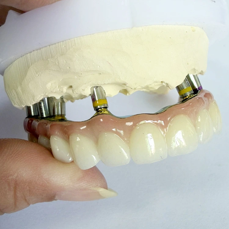 All On X Zirconia Over Bar